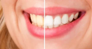 Teeth Whitening Your Route to a Brighter, More Confident Smile