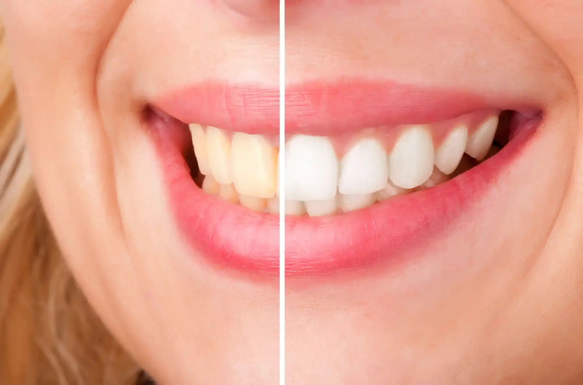 Teeth Whitening Your Route to a Brighter, More Confident Smile